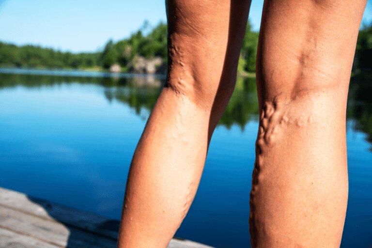 legs with varicose veins by lake